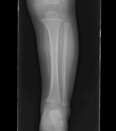 Toddlers Fracture Tibia